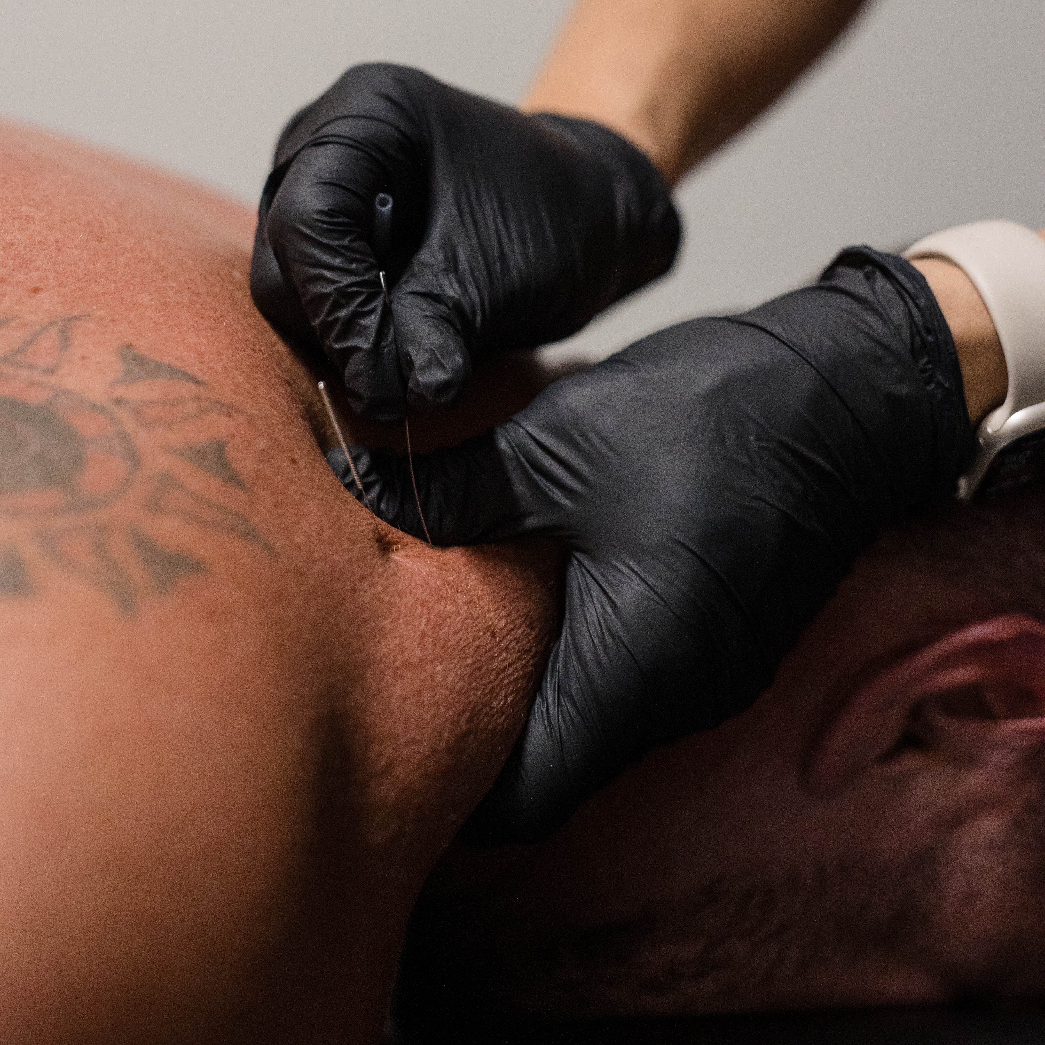 dry needling